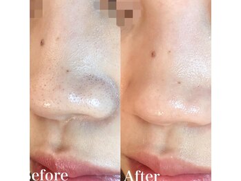 チュチュ(TUTU)/毛穴洗浄×ハーブトリートメント