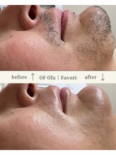 オフオルファヴォリ(OF Olu:Favori)&nbsp;痛くない 光脱毛☆
