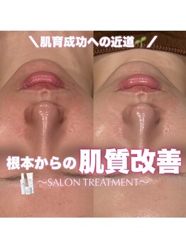 ジェノール 2nd beauty studio 姫路駅前店(JNOEL)/根本からの肌質改善！
