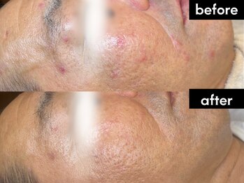 ヘアーアンドエステ ハラダ 滝ノ水店/アンストレス3+コモデックス1