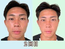 ナチュラルビューティーフェイス 横浜(NBF)/２回目MENS小顔矯正