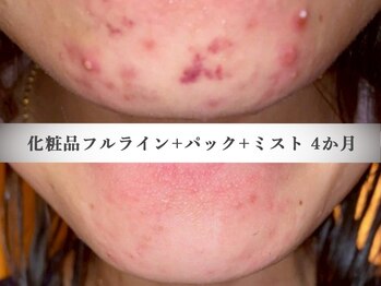 モルティー 宇都宮東店(Molti)/ニキビケア/角質除去/肌質改善