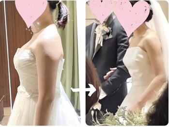 ソウ バイ ソウ(So by 蒼)の写真/≪肩幅矯正－3cm≫日本唯一の専門術で、ドレスが似合う華奢な肩&背中へ。整った肋骨/肩甲骨/細二の腕/美乳