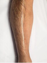 ベルシュドメール(Belle Sud Mer)/WAX脱毛