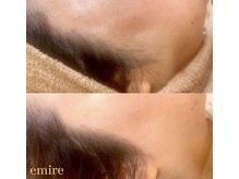 エミレ(emire)/もみあげワックス脱毛
