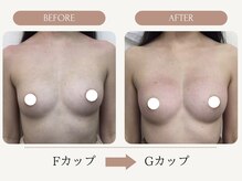 ウェルバスト(Well Bust)/【バストアップ例】E→Fカップ