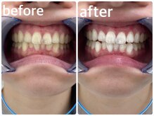 エクシアホワイトニング 日本橋店/ホワイトニング