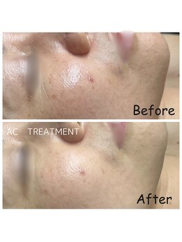 ルルマル(lulumalu)/AC　トリートメント