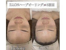 ラ ミュエル(La miel)/結果重視！韓国ILLONハーブ