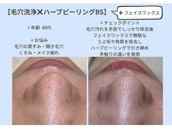 ビオルブ(VIOLVE)/毛穴洗浄/ハーブピーリング/徳島