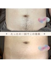 バーン 長崎 諫早(BURN)/脱毛beforeafter