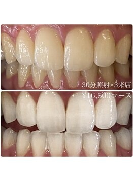 ホワイトニングルーム 川崎店(WhiteningRoom)/ホワイトニング/川崎