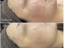 ミレット(Miretto)/【ニキビ・しみ】水光ピーリング