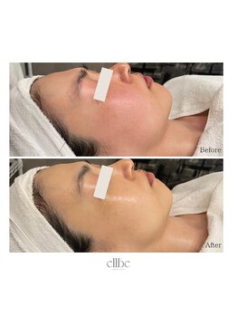 エルベ(ellbe)/リアボーテタラソトリートメント