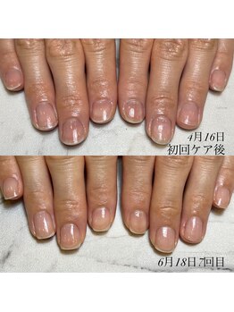 自爪育成3ヵ月コース