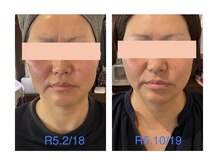 ベッラドンナ(Bella donna)/お顔引き締めBeforeAfter