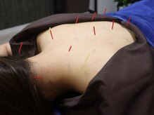 鍼灸整体院アレンジ/背中鍼灸で首肩こり改善♪