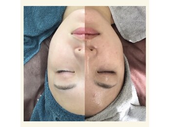 ルノン(LUNON)/セルマントリートメント集中ケア