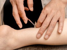 はりきゅうすず風/鍼の様子