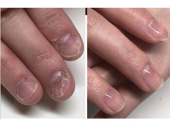 ティアラネイル 宇都宮/深爪矯正