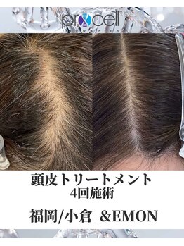 アンドエモン(&EMON)/【頭皮】プロセル効果