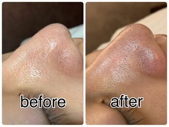 ウララ(ulala)/毛穴黒ずみケア1回目