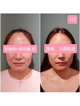 エルアンドエス(L&S)/小顔キープでハリ・ツヤも！