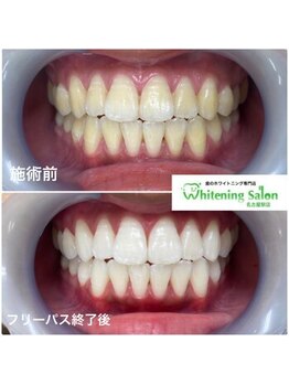 ホワイトニングサロン 名古屋駅店/【ホワイトニング施術例】