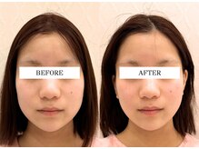 ハリランス(HARILANCE)/人中伸び/中顔面短縮