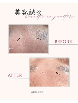 鍼灸院 ＨＡＲＩｅｙｕ/