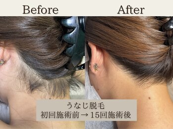 インベスト(INVEST)/うなじ脱毛