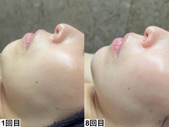 アンドミー 高崎店(&me)/ララピール【艶肌/美白/くすみ】