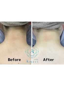 サロンアメリ イオンモール綾川店(Salon Ameri)/香川　脱毛　うなじ脱毛　アメリ