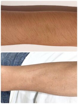 カシワビューティーココ(kashiwa beauty coco)/ひじ下脱毛