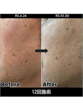 レイジー(Raygee.)/メンズヒゲ脱毛