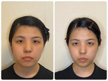 シエル(CIEL)/フェイスラインスッキリ