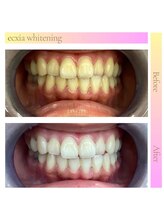 エクシアホワイトニング 明石店/ホワイトニング体験/記念写真