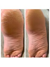 シャナ(Shana)/カーボキシーボディ(足の裏)