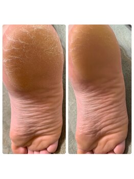 シャナ(Shana)/カーボキシーボディ(足の裏)