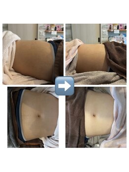 ルソワン(Le.soin)/お腹ビフォーアフター