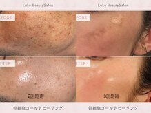 ルーク(Luke)の雰囲気(埼玉県初導入の幹細胞ゴールドピーリング☆毛穴/ニキビ/しみ)