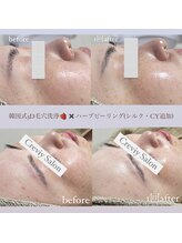 クレヴィー(Creviy)/韓国式3D毛穴洗浄×ハーブ1回