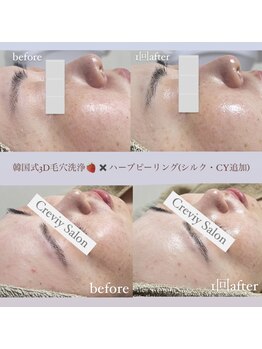 クレヴィー(Creviy)/韓国式3D毛穴洗浄×ハーブ1回
