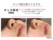 アルゴ 吹田千里山駅前店(ALGO)/【キッズ脱毛】