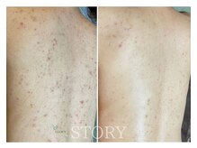 ストーリー(STORY)/ハーブピーリング専門店STORY