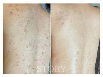 ストーリー(STORY)/ハーブピーリング専門店STORY