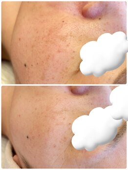 ライブ ストーリー(Live story)/プラズマ×LDM５回の変化