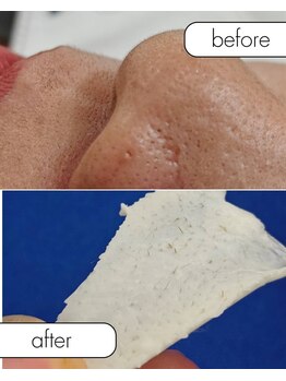 アルマサロン 菊陽(Almasalon)/レディースのうぶ毛取り