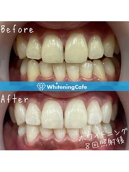 ホワイトニングカフェ 三島店/★Before→ After