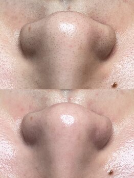 バーム(BAUM.)/長年の溜めた汚れ一斉除去!